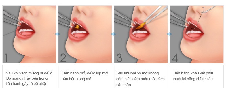 quá trính lấy mỡ túi má