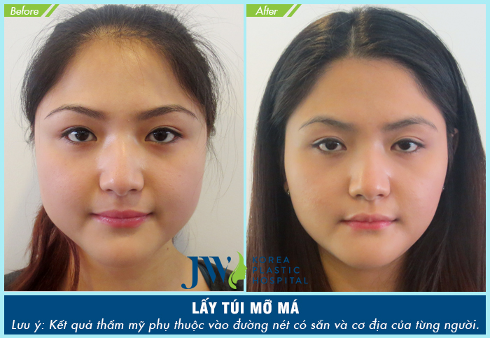 trước và sau lấy mỡ túi má