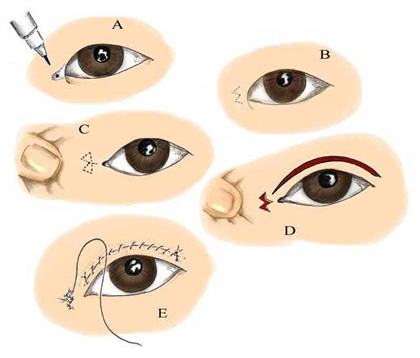 Mở rộng khóe mắt