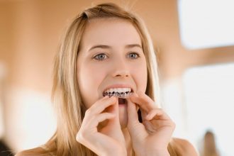 Phẫu thuật răng vẩu áp dụng trong trường hợp nào?