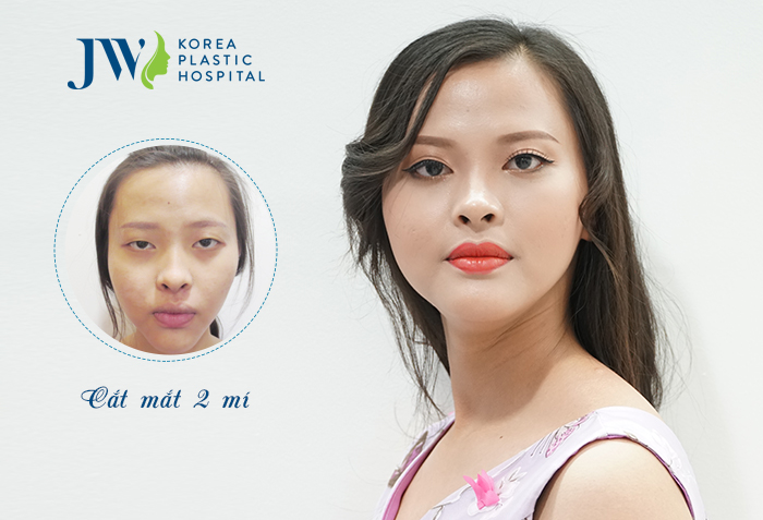 Cắt mí mắt ở đâu đẹp - Bệnh viện thẩm mỹ uy tín-hình 6