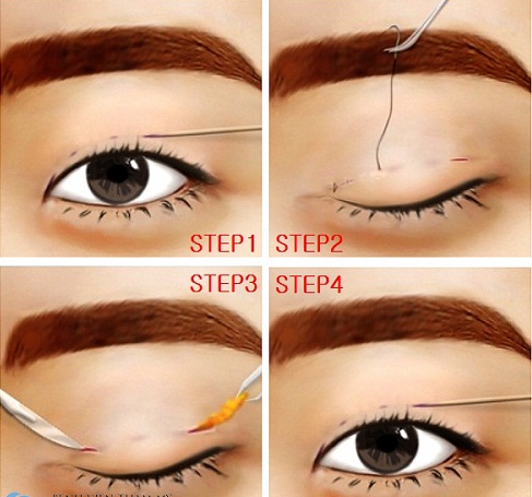 Cắt mí mắt ở đâu đẹp - Bệnh viện thẩm mỹ uy tín-hình 3