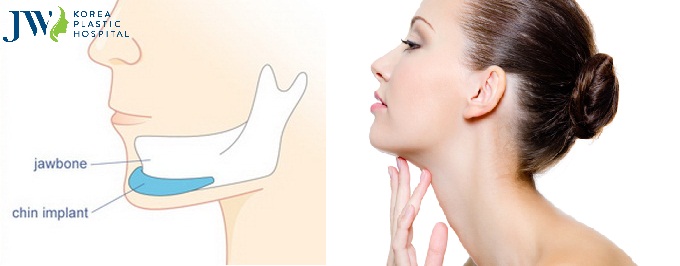 Độn cằm V line cho mặt vuông to bè an toàn chuẩn đẹp