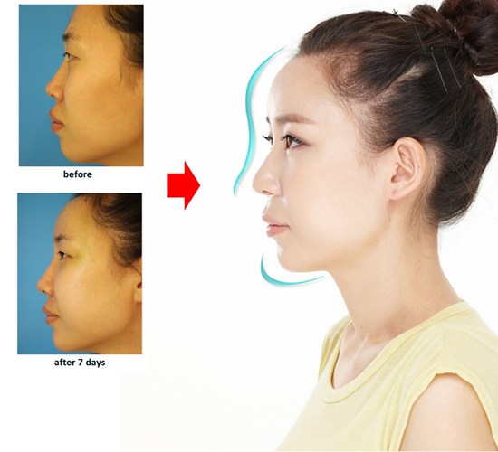 Độn trán giá bao nhiêu tại Việt Nam công nghệ Hàn Quốc