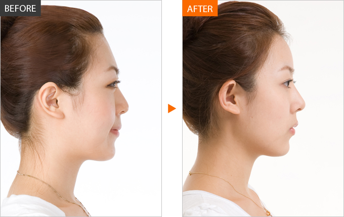 Khác biệt trước và sau khi thẩm mỹ