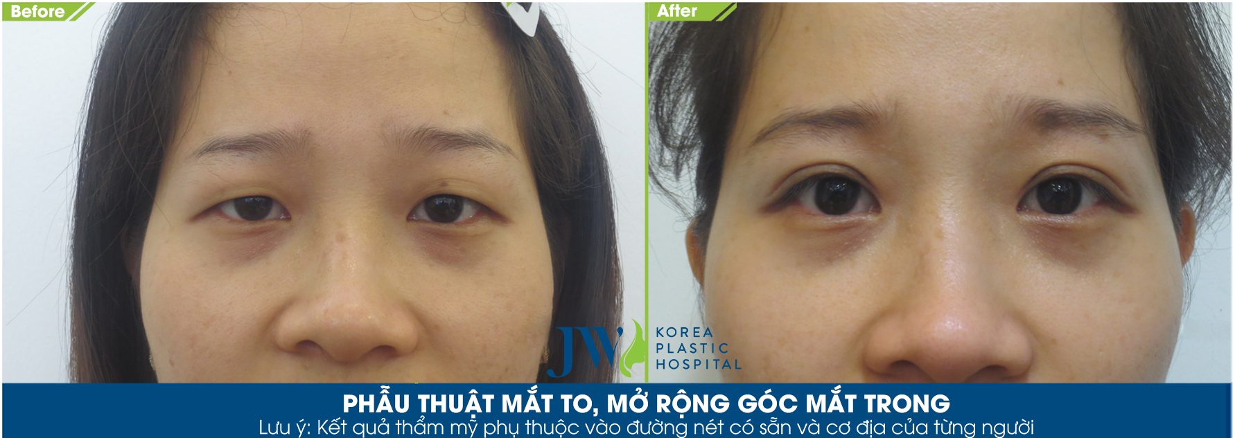 phẫu thuật mắt to