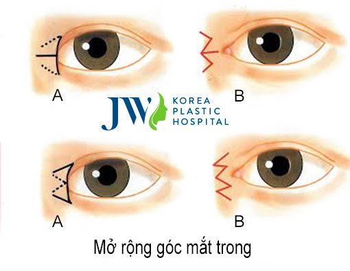 mở rộng khóe mắt