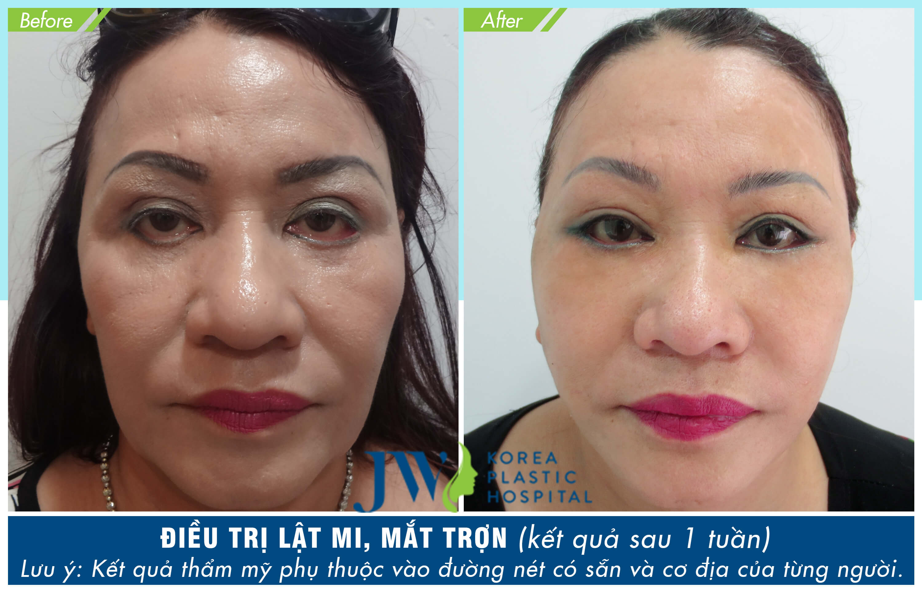 lấy mỡ bọng mắt