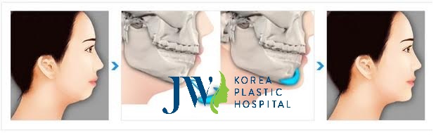 Độn cằm V Line ở đâu đẹp nhất hiện nay? Độn cằm V line ở đâu đẹp TPHCM?