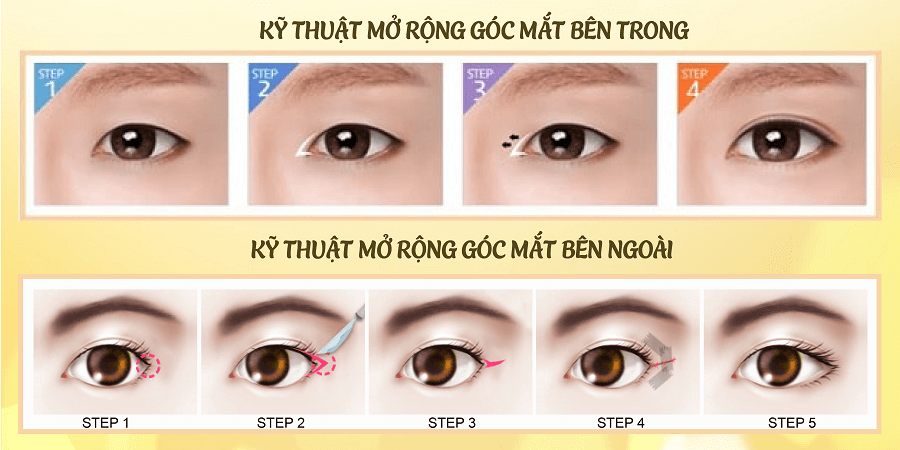 Cắt mắt to - 60 phút mắt đẹp chuẩn Hàn - Duy trì vĩnh viễn - Ảnh 3