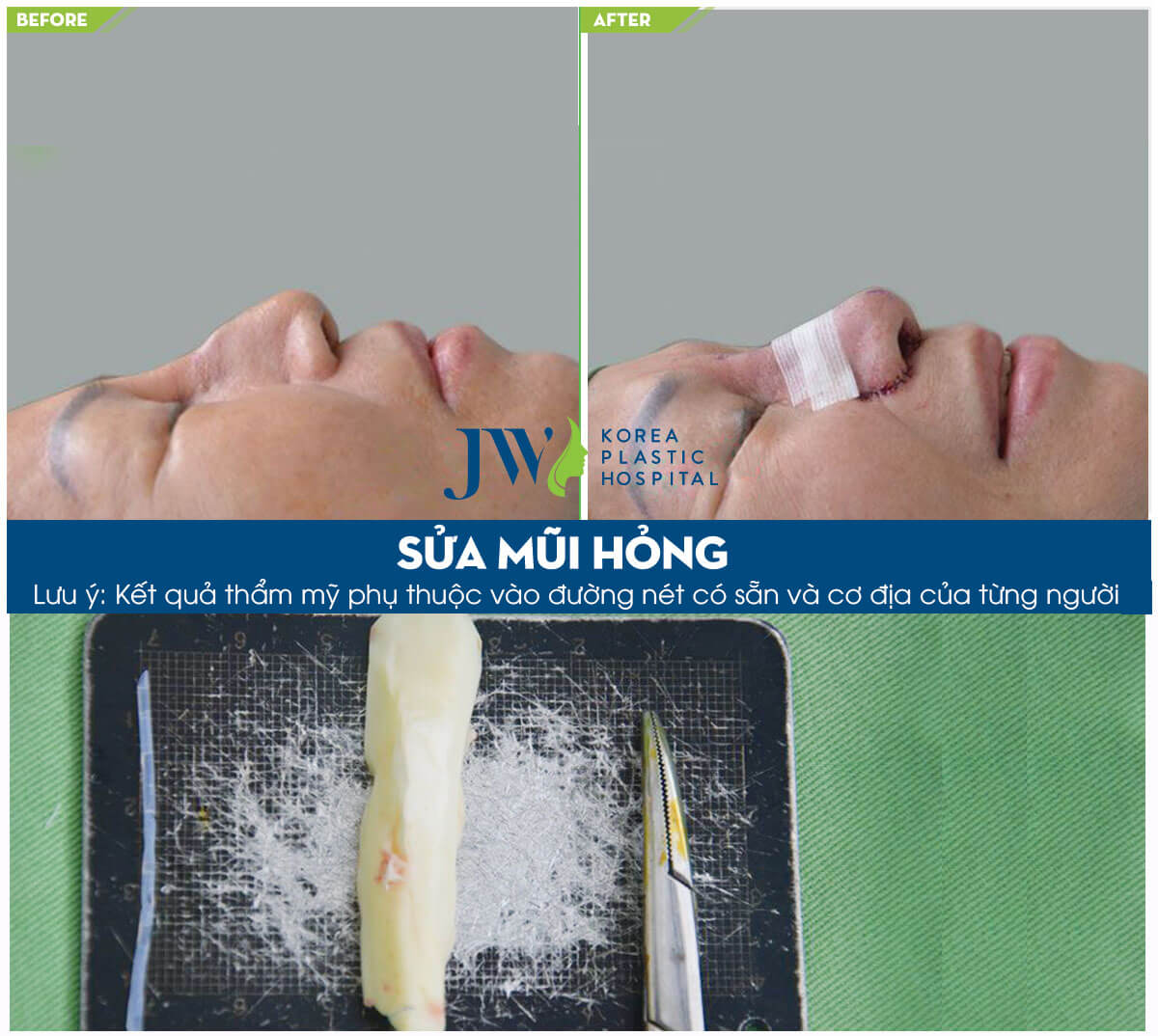 Sửa mũi đã phẫu thuật - Trải nghiệm người trong cuộc - Ảnh 3
