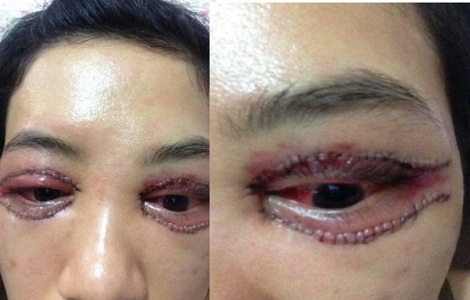 Cắt mí mắt và biến chứng ở trung tâm thiếu uy tín