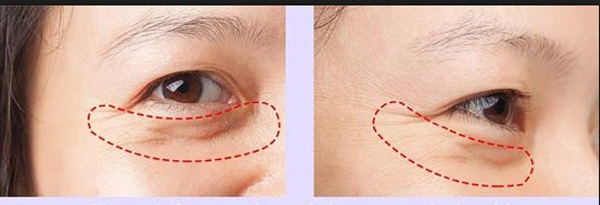 Lấy mỡ bọng mắt