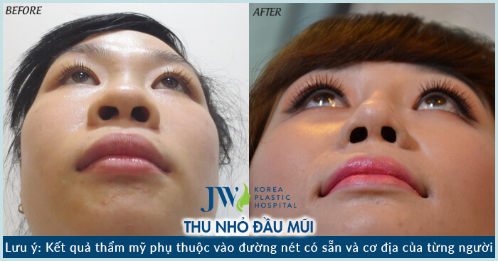 hình ảnh thu gọn đầu mũi