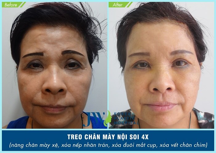 treo chân mày