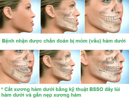 phau-thuat-ham-mom-2