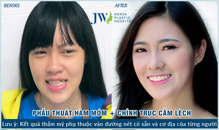 Phẫu thuật hàm móm