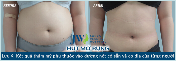 hút mỡ bụng