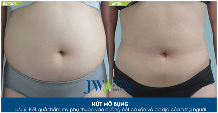 Hút mỡ bụng