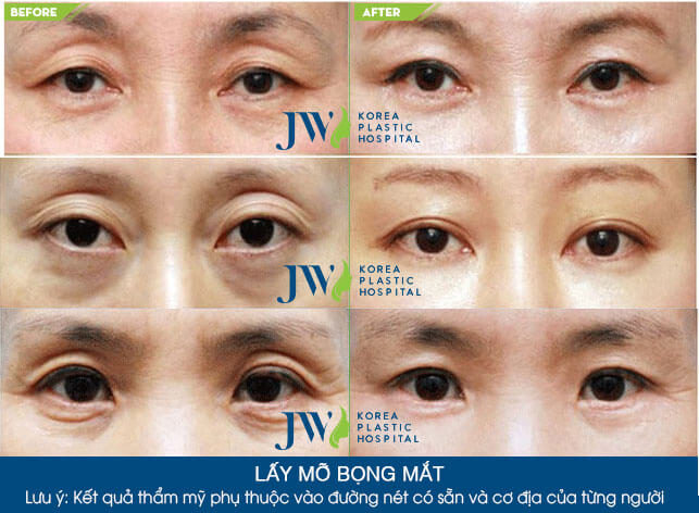 lay-mo-bong-mat-3