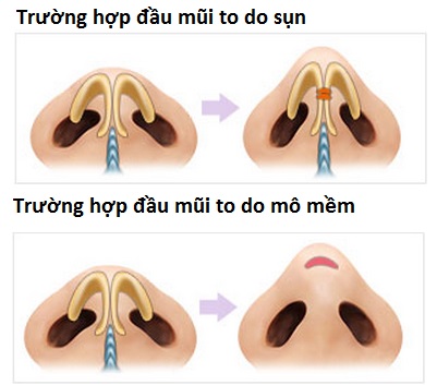 thu-gon-dau-mui-2