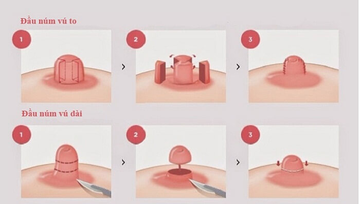 Thu gọn đầu vú có gây mất cảm giác không?_1