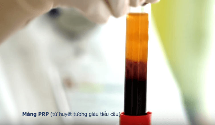 Gọt mặt V line_5