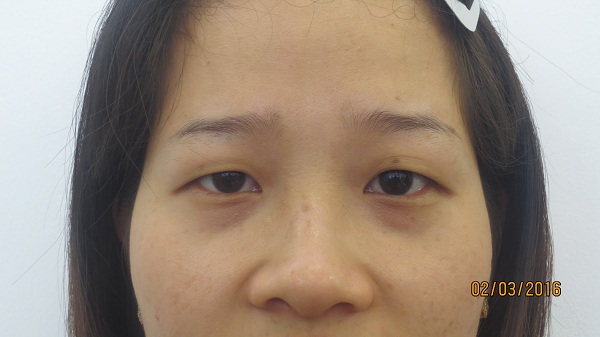 phau-thuat-mat-to-2