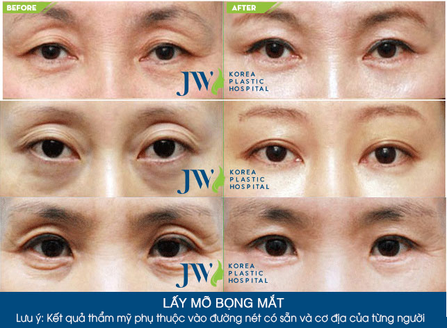 lay-mo-bong-mat-5
