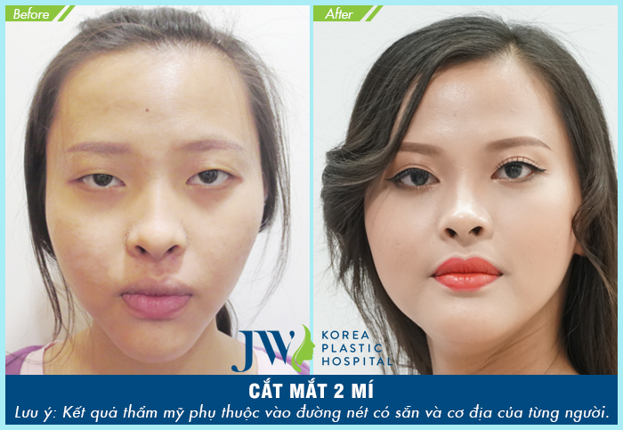 cắt mí mắt ở đâu đẹp