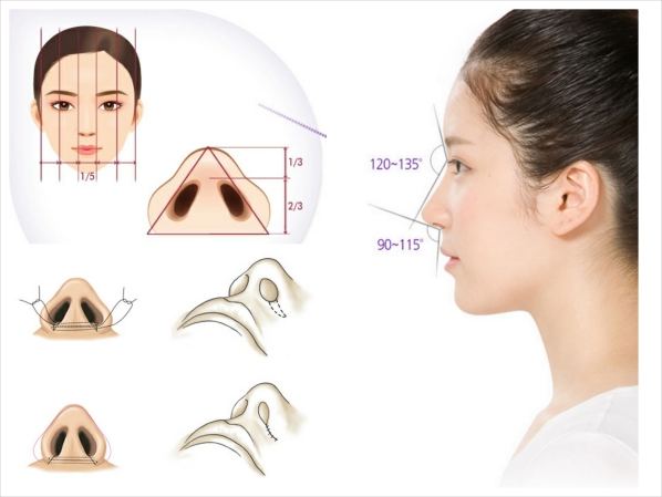 cắt cánh mũi an toàn ở đâu