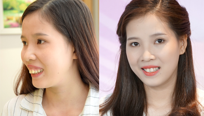 Niềng răng có hết hô hàm không – 5 điều quan trọng cần biết-hình 7