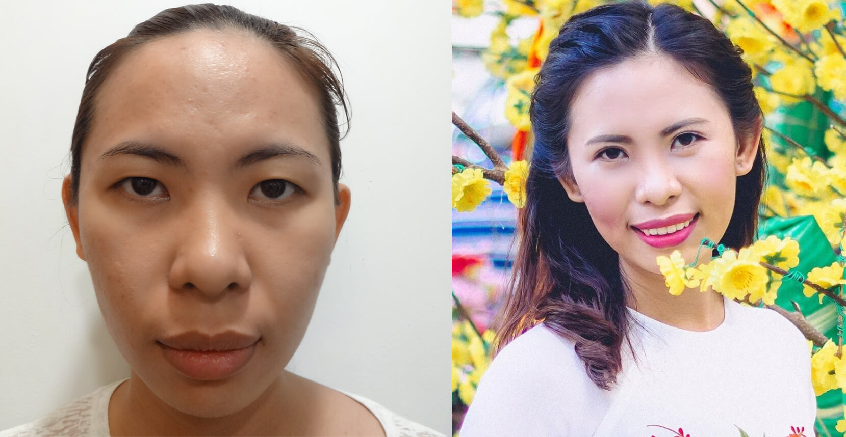 Nhấn mí mắt là gì - Nhấn mí mắt giữ được bao lâu - Điều quan trọng cần biết - Ảnh 1 - 6