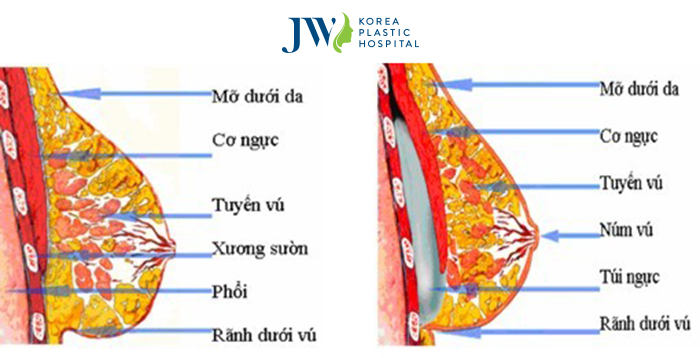 Phẫu thuật nâng ngực nội soi 6 điều cần ghi nhớ- ảnh 3