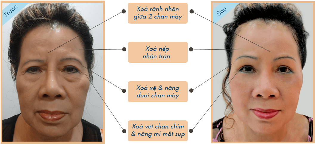Treo chân mày có để lại sẹo không - Chuyên gia tư vấn - Ảnh 2