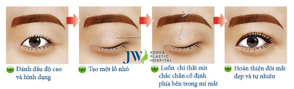 Nhấn mí mắt là gì - Nhấn mí mắt giữ được bao lâu - Điều quan trọng cần biết - Ảnh 3