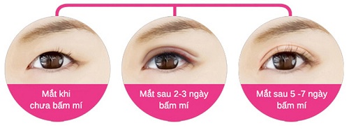Nhấn mí mắt là gì - Nhấn mí mắt giữ được bao lâu - Điều quan trọng cần biết - Ảnh 5