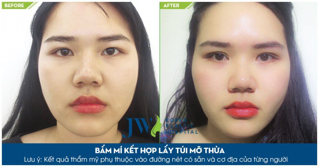 Nhấn mí mắt là gì - Nhấn mí mắt giữ được bao lâu - Điều quan trọng cần biết - Ảnh 7
