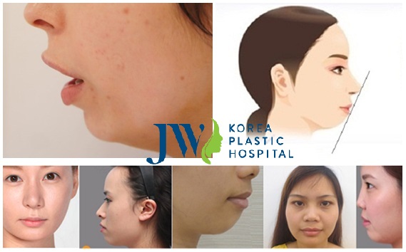 Phẫu thuật trượt cằm - Cằm đẹp tự nhiên không còn khuyết điểm - Ảnh 4