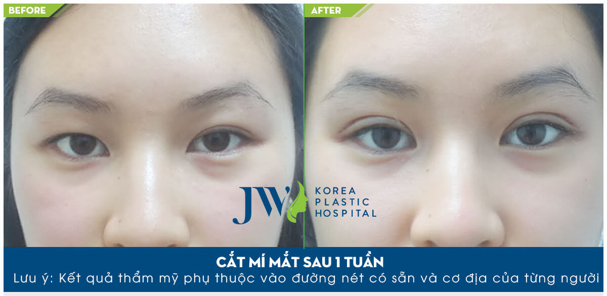 cắt mí mắt nên hay không- hình 9