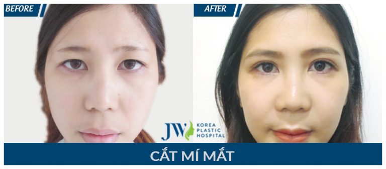 cắt mắt 2 mí-hình 8