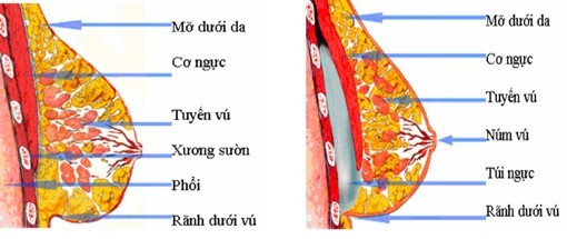 Treo tuyến ngực cải thiện vòng một chảy xệ sau sinh - Ảnh 2