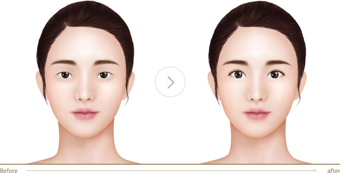 cắt mí mắt nên hay không- hình 2