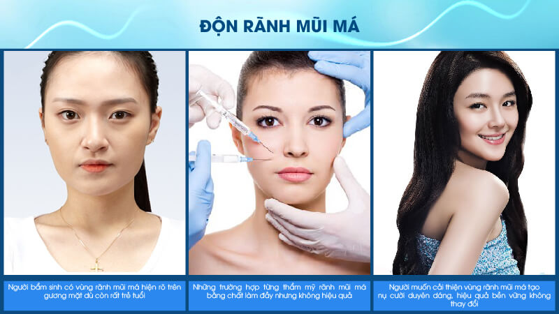 Độn rãnh mũi má tôn tạo nụ cười duyên dáng chỉ 45 phút - Ảnh 4