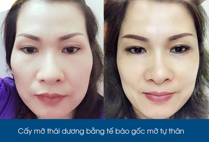 don-thai-duong-bang-te-bao-goc-mo-tu-than