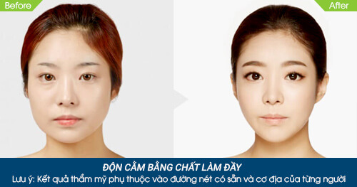 Trẻ hóa bằng chất làm đầy cho gương mặt căng tròn quyến rũ - Ảnh 6
