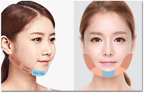 Hiểu rõ gọt mặt V Line là gì ? Nếu muốn gọt mặt đừng bỏ lỡ- ảnh 2