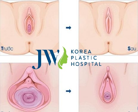 Thẩm mỹ làm đẹp vùng kín - Bí quyết giữ lửa tình yêu - Ảnh 2