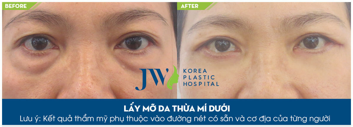 30 phút đánh bay lão hóa bằng công nghệ lấy mỡ bọng mắt - Ảnh 6
