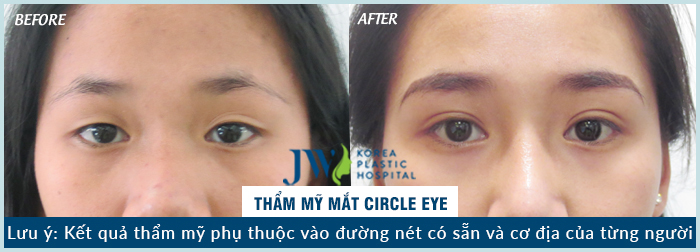 Phẫu thuật thẩm mỹ mắt ở đâu tốt nhất-hình 15
